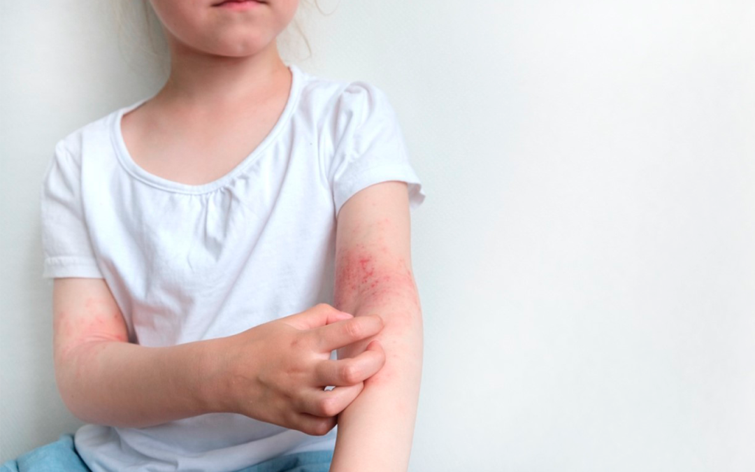 Dermatitis Atópica: dolor a flor de piel