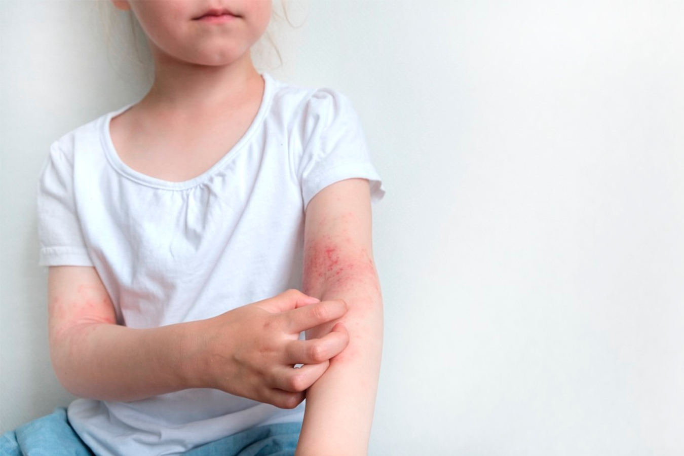 Dermatitis Atópica: dolor a flor de piel