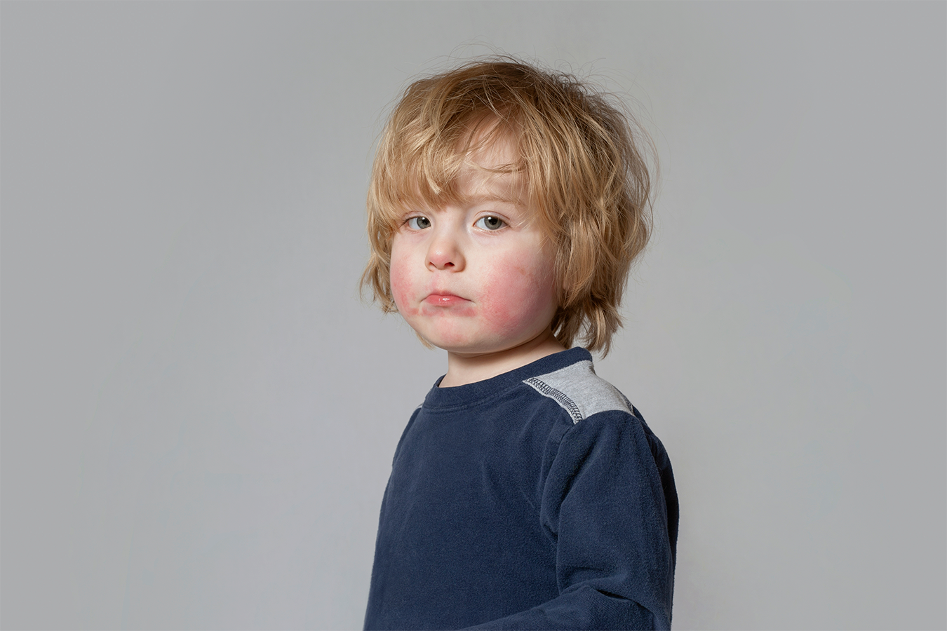 Dermatitis Atópica en Chile: un desafío en aumento en niños y adultos